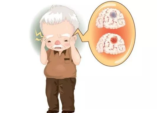 择思达斯：如何预防帕金森综合症